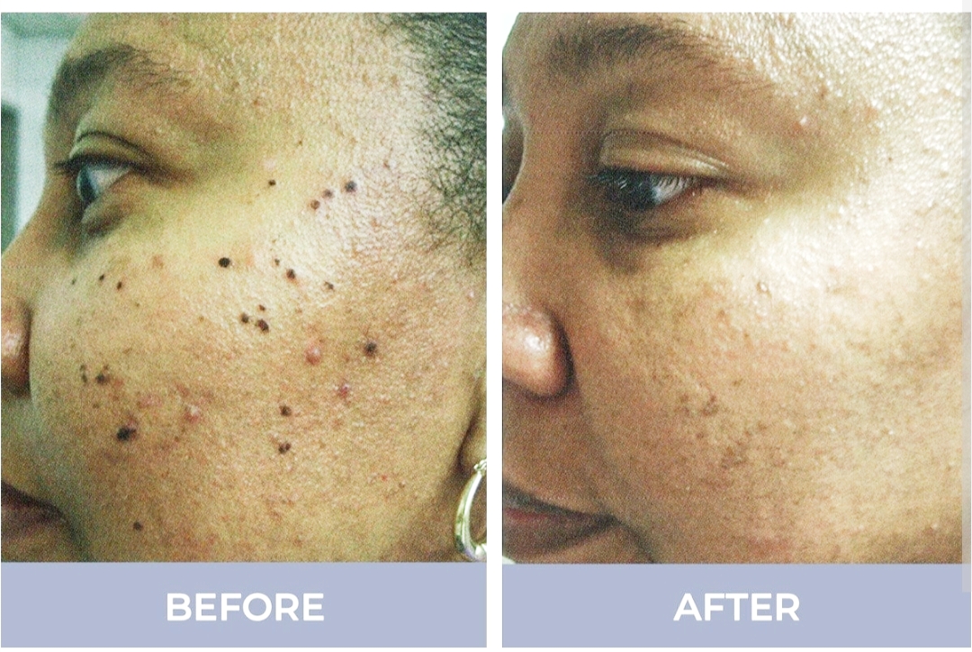 Skin Treatment Result 1