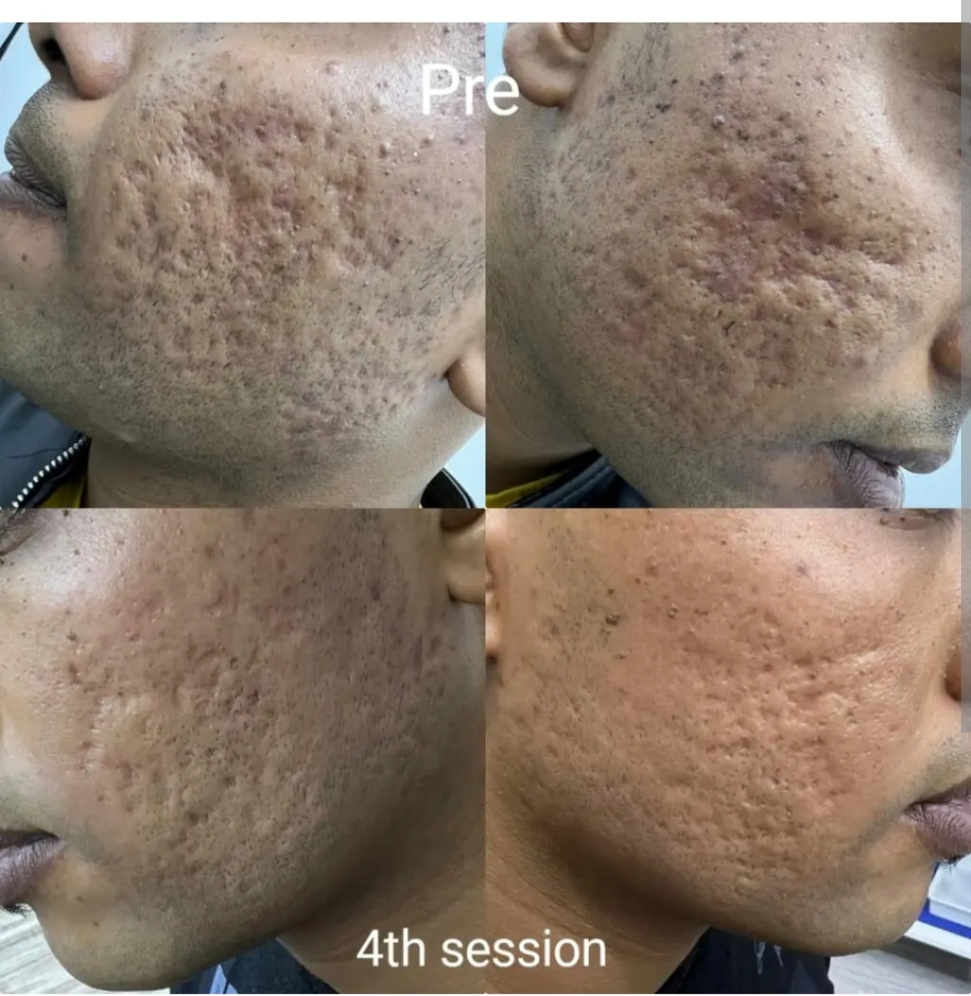 Hair Treatment Result 2
