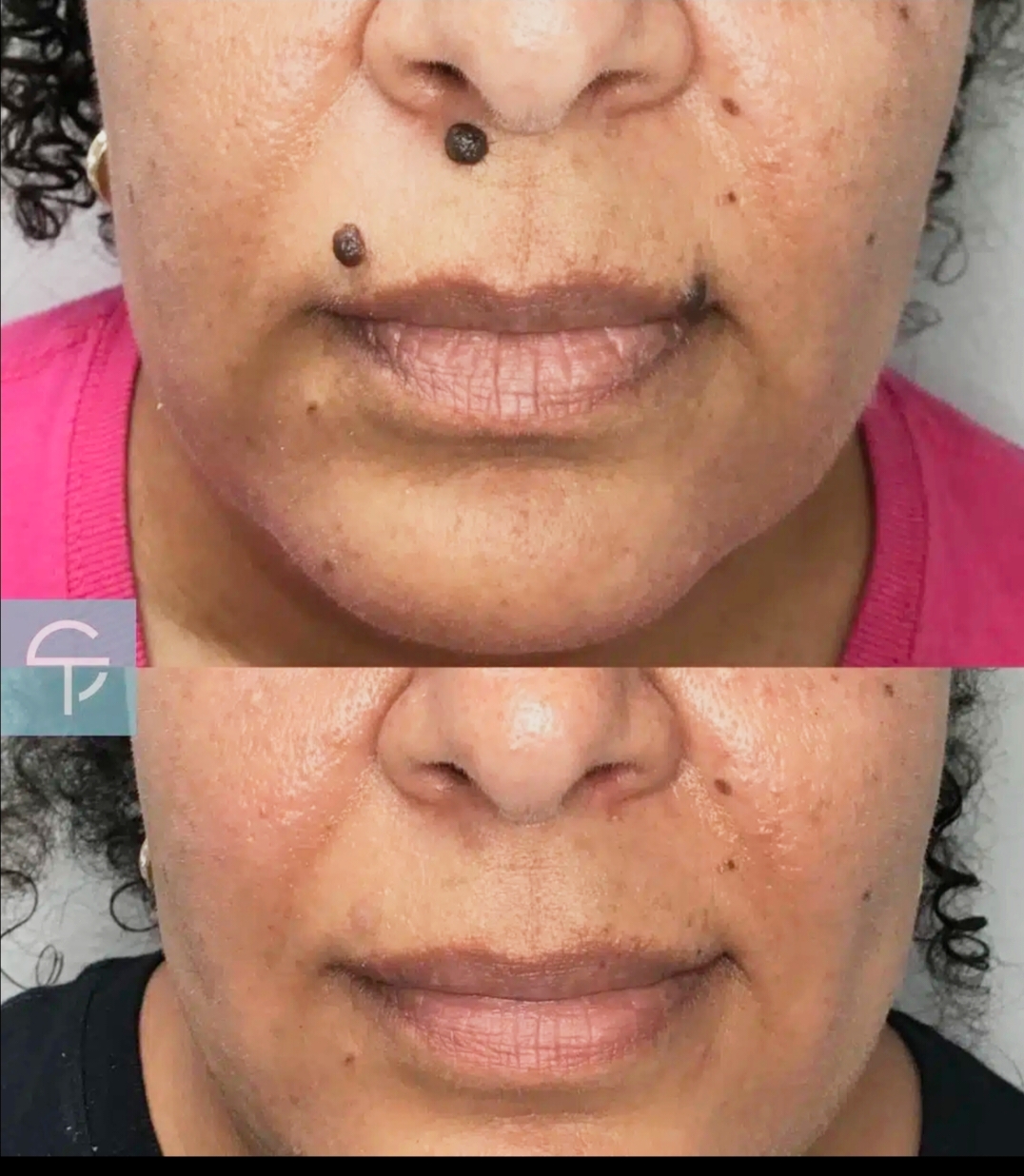 Skin Treatment Result 2