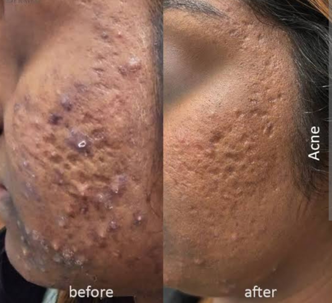 Laser Treatment Result 2