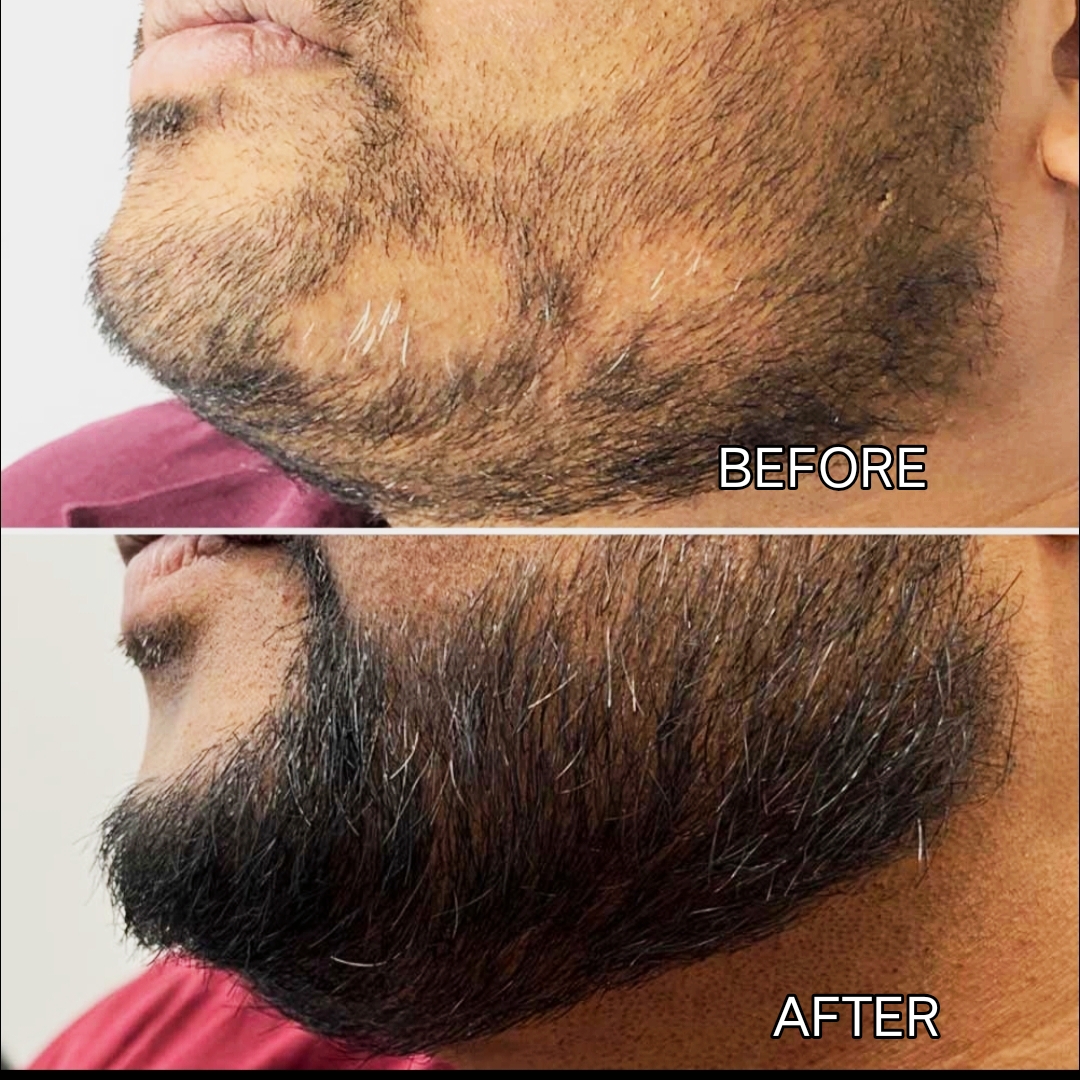 Laser Treatment Result 1