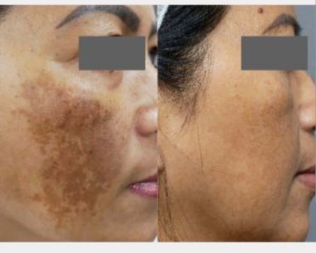 Skin Treatment Result 4