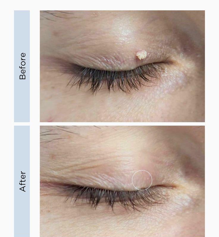 Facial Treatment Result 2