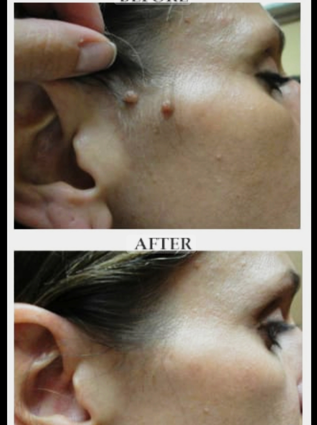 Laser Treatment Result 3