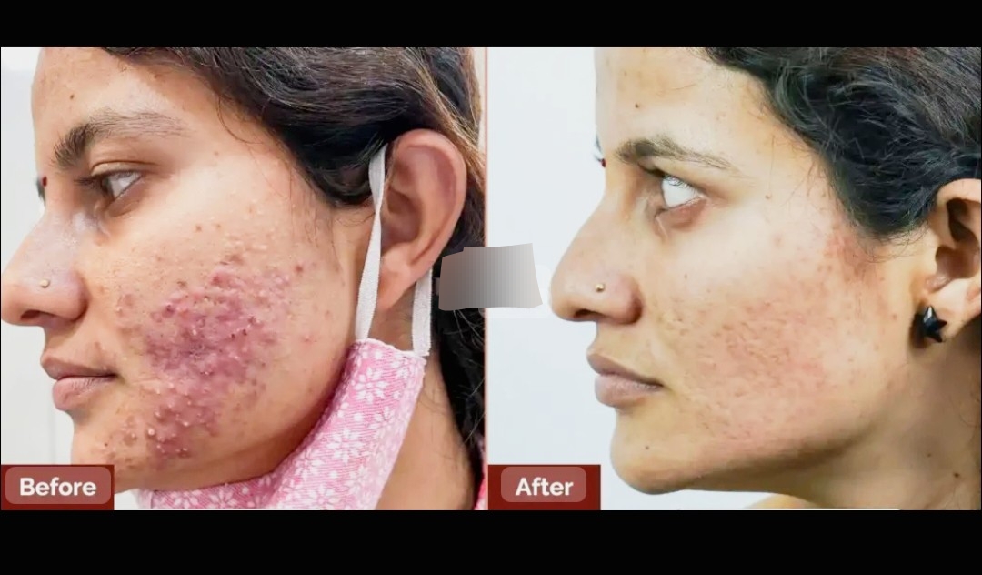 Laser Treatment Result 5